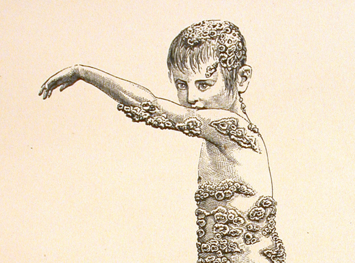 Dr. Roddick’s Remarkable Case of Favus, Showing the Distribution of the Scabs and the Extent of the Eruption on the Body