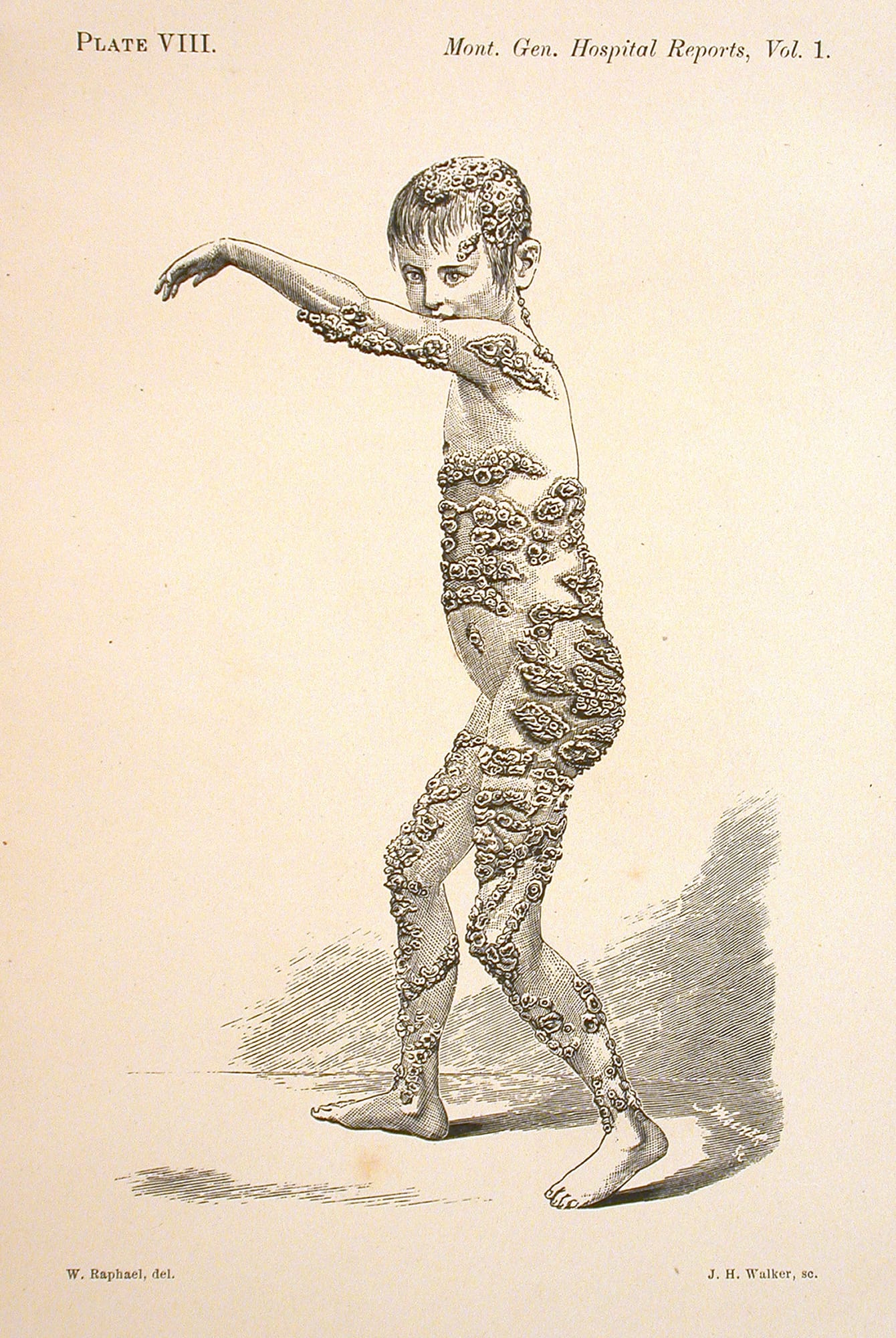Dr. Roddick’s Remarkable Case of Favus, Showing the Distribution of the Scabs and the Extent of the Eruption on the Body